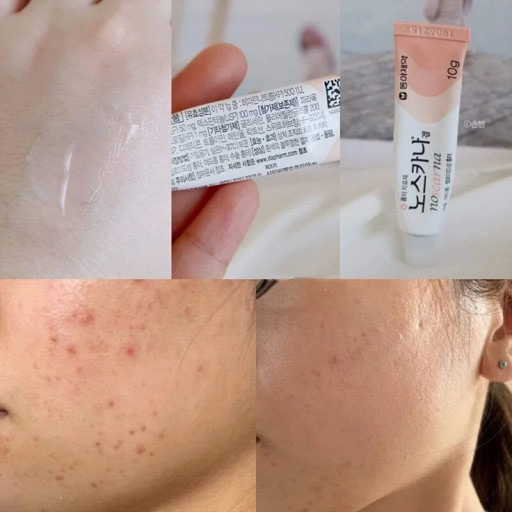 Dong -A Pharm NoScarna Gel Гель от постакне и шрамов — изображение 4